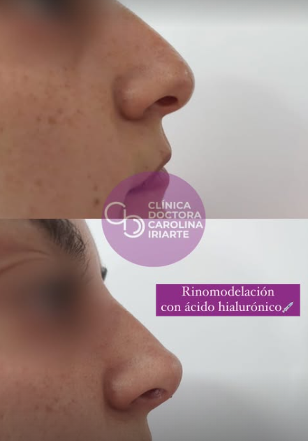 Antes y después de rinomodelación con ácido hialurónico