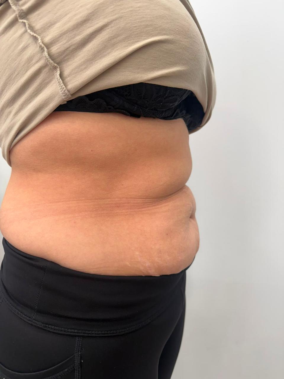 Antes de tratamiento Endoláser de abdomen